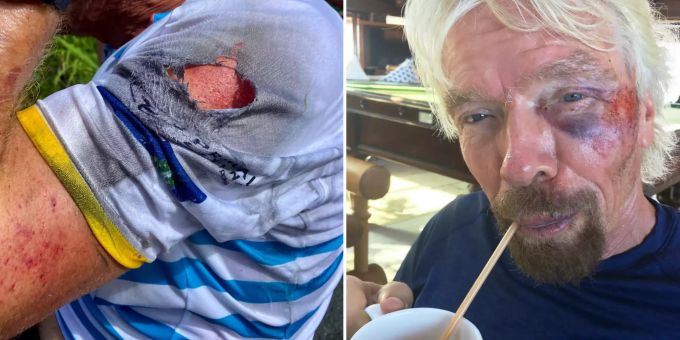 Richard Branson ist vom Velo gestürzt. Richard Branson