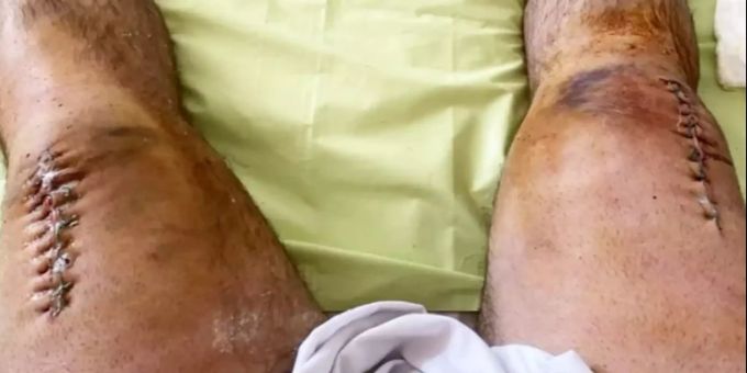Alexander Sedykh postet dieses Foto nach der Operation auf Instagram. Gewichtheben