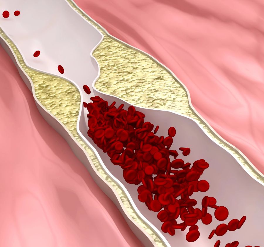 Ablagerungen in den Blutgefässen begünstigen Arteriosklerose.