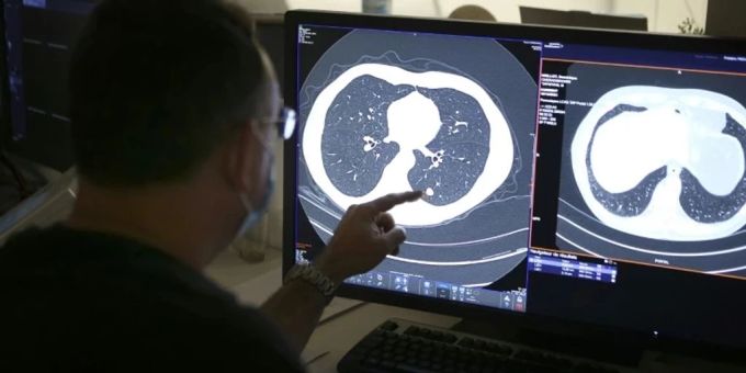 Neue Studie warnt - Flut an Krebsfällen trifft bald viele Länder