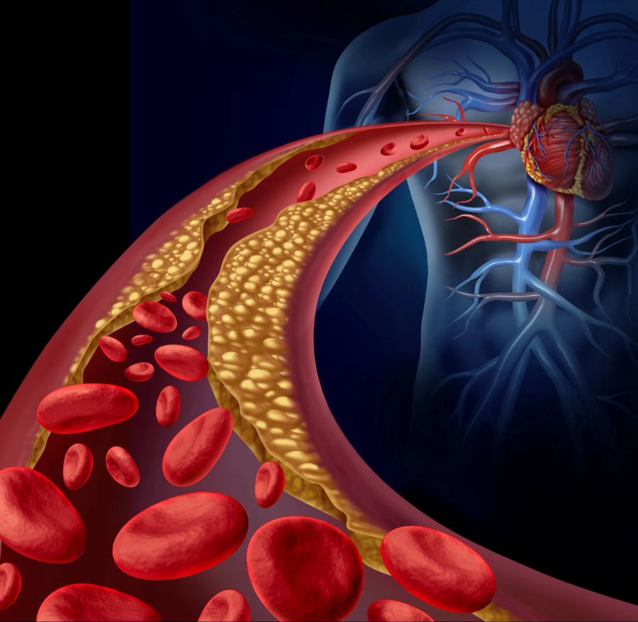 Verengte Arterien