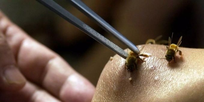 Akupunktur mit Bienen kann gefährlich werden. Akupunktur mit Bienen kann gefährlich werden.