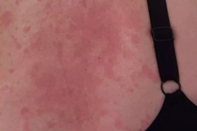 Bei einer Britin äusserte sich ihre Infektion mit dem Coronavirus in einem Hautausschlag. Coronavirus
