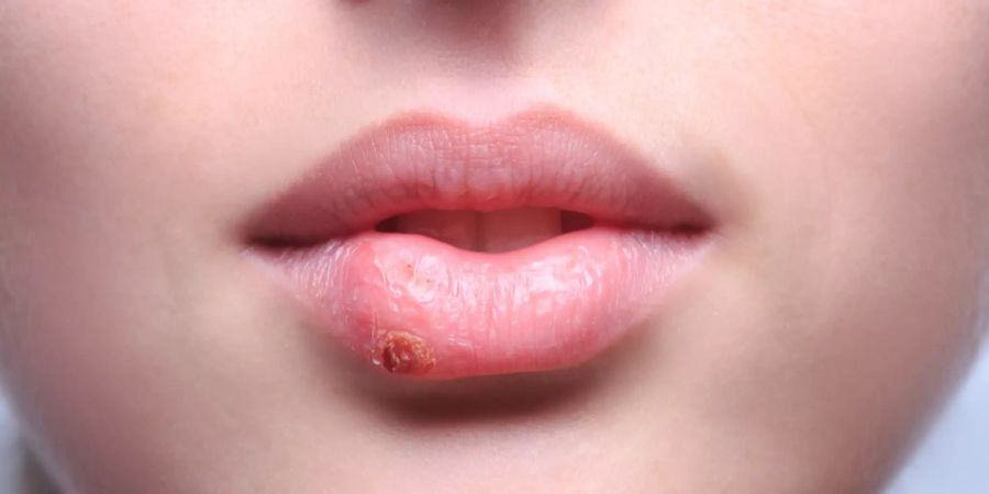 Lippenherpes