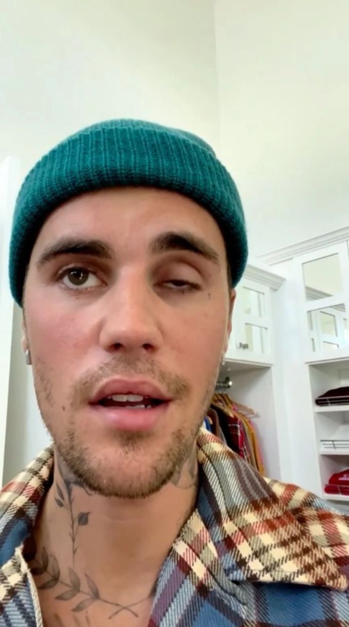 Das halbe Gesicht von Justin Bieber ist zurzeit gelähmt. justin bieber gesichtslähmung