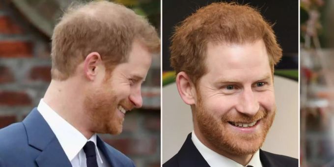 Keine Lust auf Glatze - Prinz Harry geht in die Haarklinik