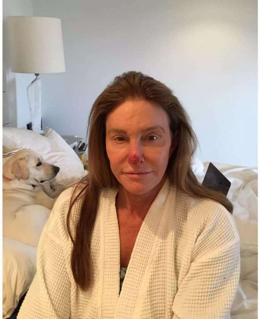 Reality-Star Caitlyn Jenner musste sich Hautkrebszellen von der Nase entfernen lassen.