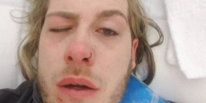 Prügelattacke an Fasnacht - Homosexueller wird spitalreif geprügelt