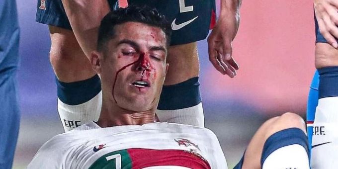 Cristiano Ronaldo wurde beim Nations-League-Spiel gegen Tschechien im Gesicht verletzt. Cristiano Ronaldo