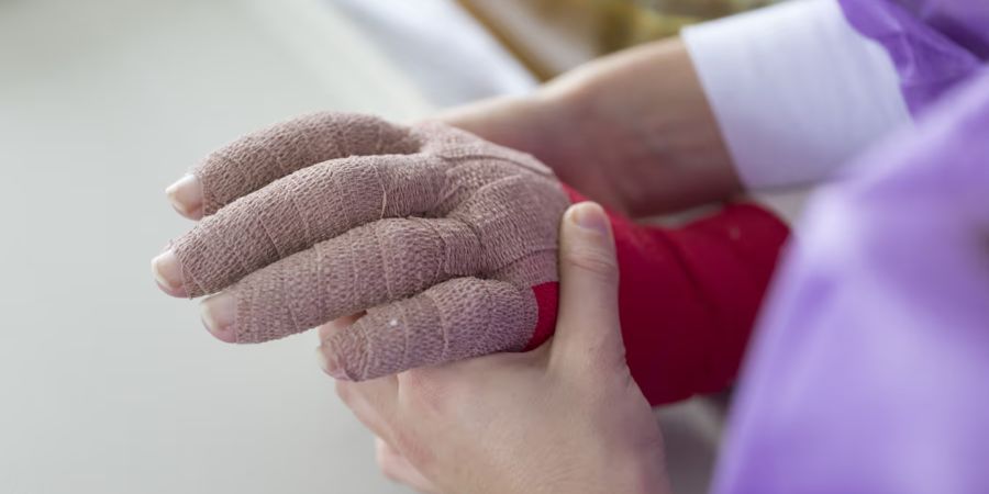 Die 32-Jährige hat bereits drei Transplantationen hinter sich – nun baut sie sich ein «neues Leben auf verbrannten Fundamenten» auf. (Symbolbild)