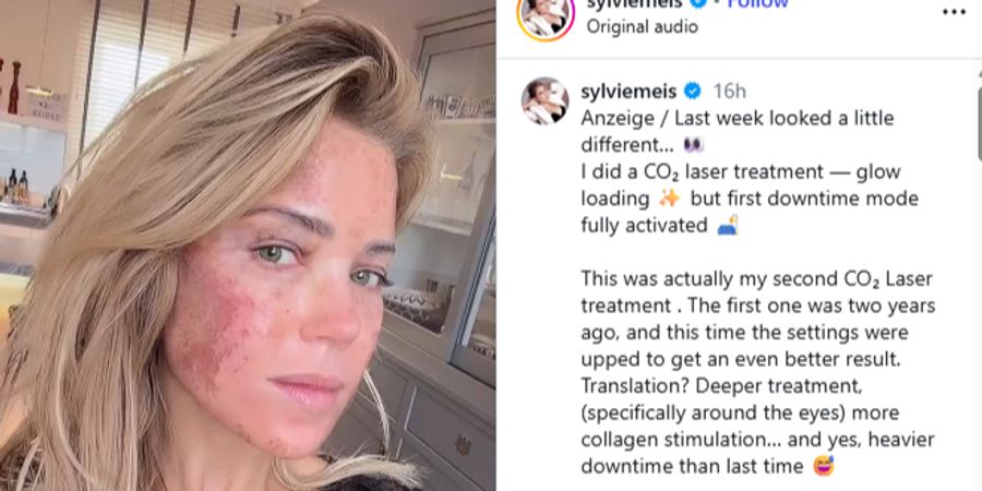 Sylvie Meis hat eine CO₂-Laserbehandlung gemacht – schon zum zweiten Mal.