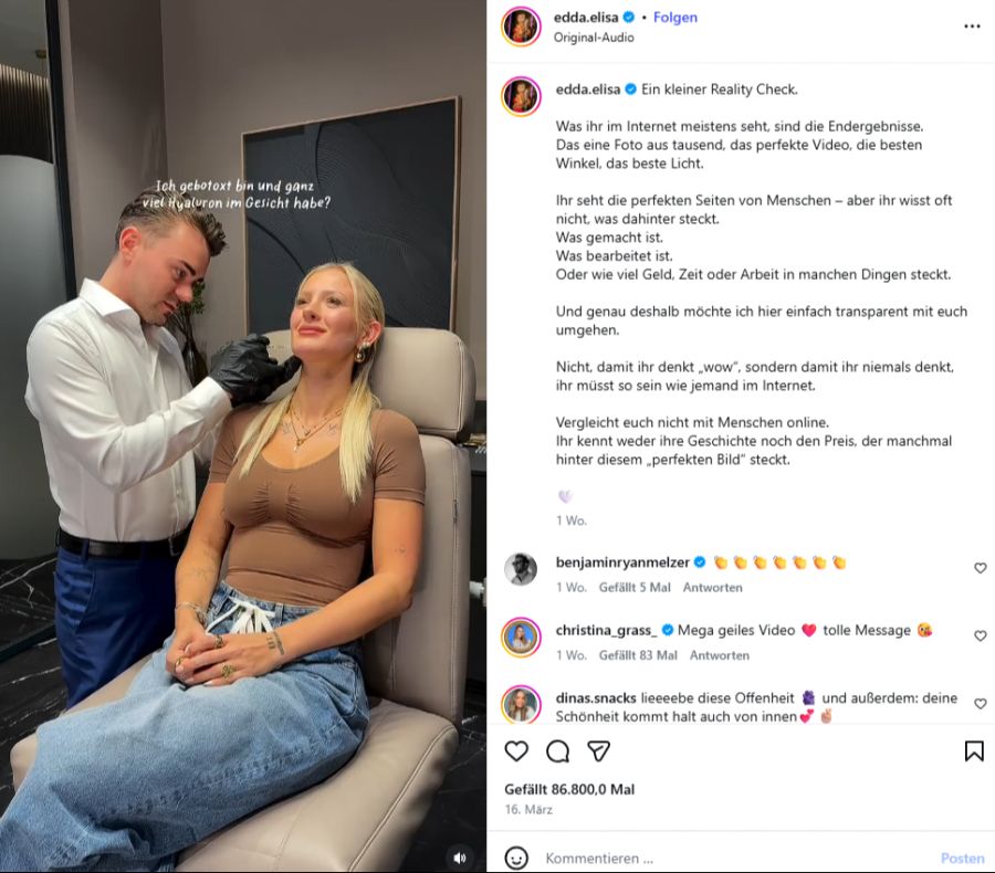 Auch im Gesicht hilft sie nach: Botox an drei Stellen und Hyaluron in den Lippen.