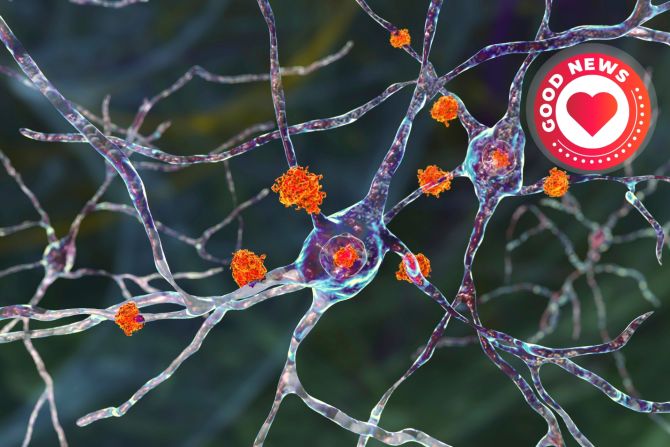 Gehirn Verklumpungen Proteeine Alzheimer