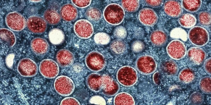 Wegen einer neuen Mpox-Variante ruft die WHO die weltweite Notlage aus. Mpox