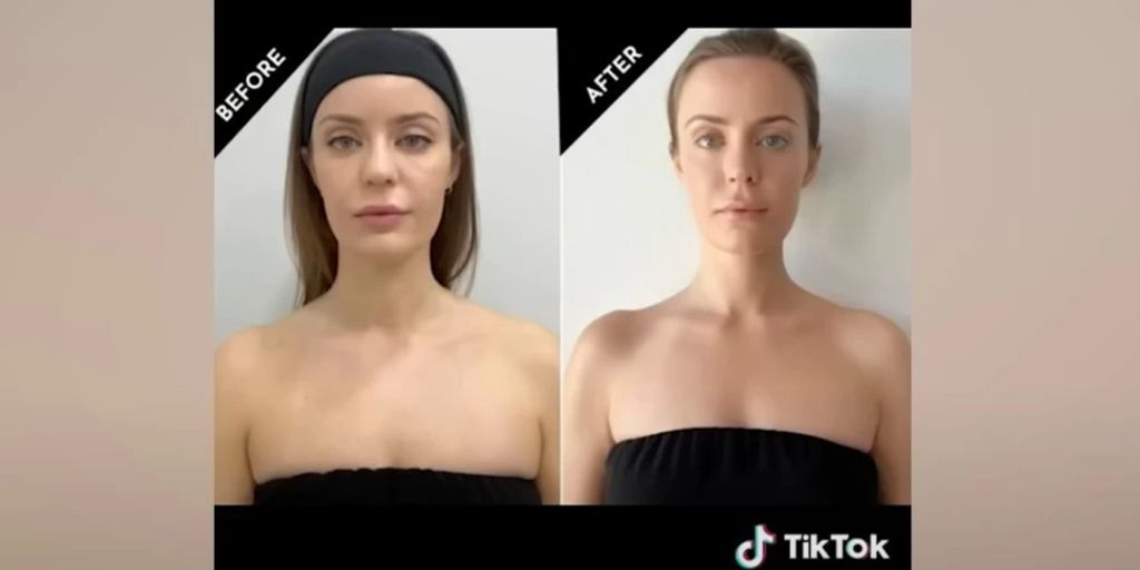 «Barbie Botox» Was steckt hinter der Schönheitsbehandlung?