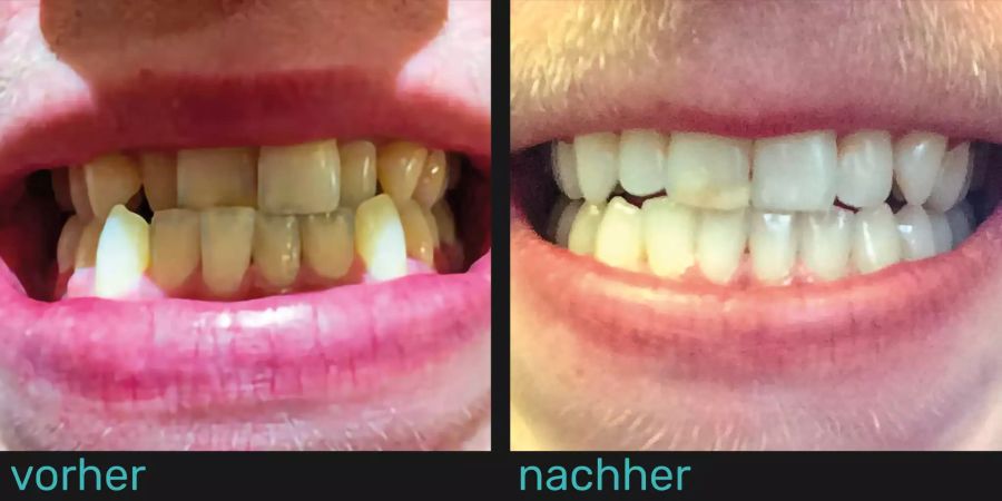 Zähne vor und nach Gebrauch der durchsichtigen Zahnspange.
