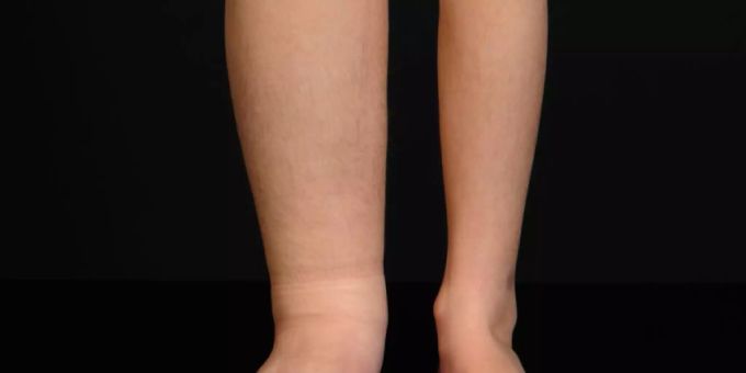 Lymphödem bei einem Kind. Normalerweise wird es mit Kompression oder Drainage behandelt - vorübergehend. Prof. Nicole Lindenblatt vom Kinderspital Zürich hat nun erstmals in der Schweiz einen Lymphknotentransfer an einem Kind durchgeführt, um das Problem auf Dauer zu beheben (Pressebild). Lymphödem bei einem Kind. Normalerweise wird es mit Kompression oder Drainage behandelt - vorübergehend. Prof. Nicole Lindenblatt vom Kinderspital Zürich hat nun erstmals in der Schweiz einen Lymphknotentransfer an einem Kind durchgeführt, um das Problem auf Dauer zu beheben (Pressebild).