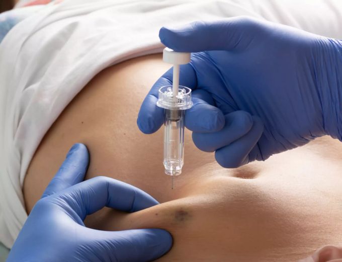 COVID-19 Pneumonie-Patient erhält eine subkutane Injektion eines Gerinnungshemmers zur Vorbeugung von Thrombosen. Vorbeugung von Thrombosen
