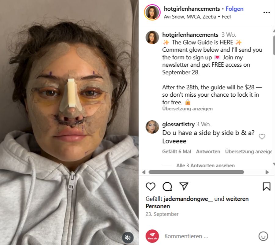 Eine Influencerin aus Kanada unterzog sich mit 28 einem operativen Facelift.