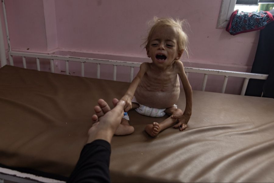 Der zweijährige Sham Qudeih ist eines der Kinder, die im Gaza-Streifen zuletzt auf Hilfe warteten - mit einer Lebervergrösserung, schwerer Unterernährung und einer starken Bauchschwellung. (Archivbild)