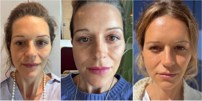 Von links nach rechts: Vor der Anwendung war meine Haut eher fahl und dehydriert. Nach vier Wochen Skin Infusion strahlt sie wie frisch aus dem Urlaub und ist unglaublich samtig. Gesicht, Hautcreme Test,