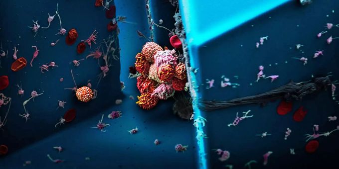 Cluster von zirkulierenden Tumorzellen, die aus dem Blut einer Patientin mit Brustkrebs isoliert wurden. Tumorzellen