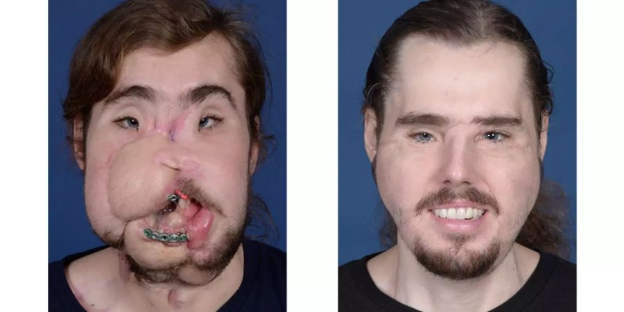 Cameron Underwood vor und nach der Gesichtstransplantation.