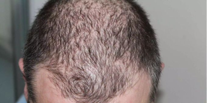 Das Cassiopea-Mittel soll bei der Testperson den Haarwuchs an den Schläfen angeregt haben. (Symbolbild) Das Cassiopea-Mittel soll bei der Testperson den Haarwuchs an den Schläfen angeregt haben. (Symbolbild)