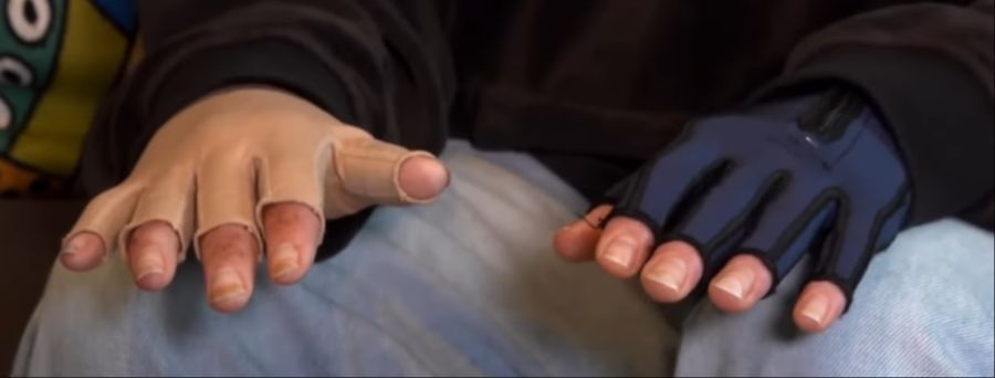 «Ich kann die Finger nicht mehr biegen, weil die Narben ziehen», sagt die 29-Jährige.