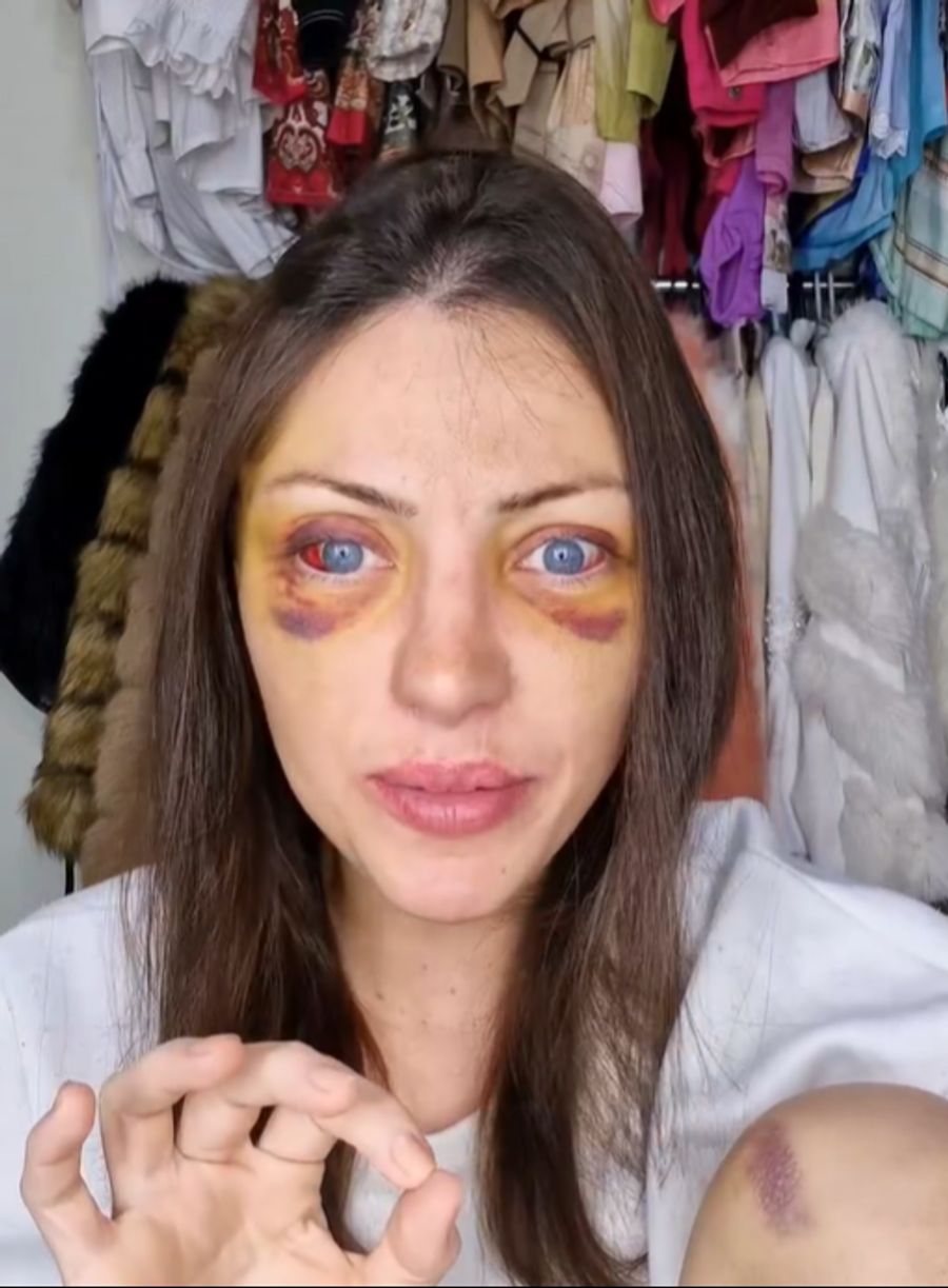 Nach einer Gesichtsstraffung schockierte sie ihre Fans mit Verfärbungen im Gesicht.