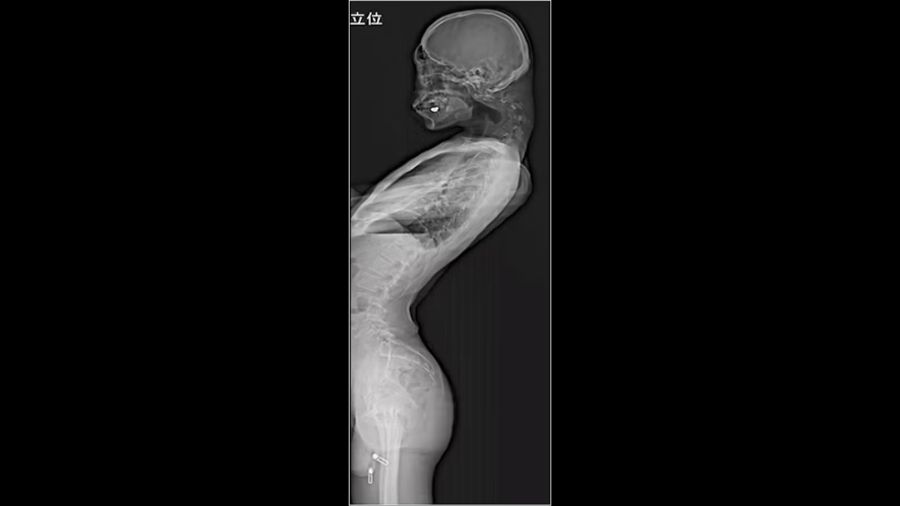 dropped head syndrom handy
