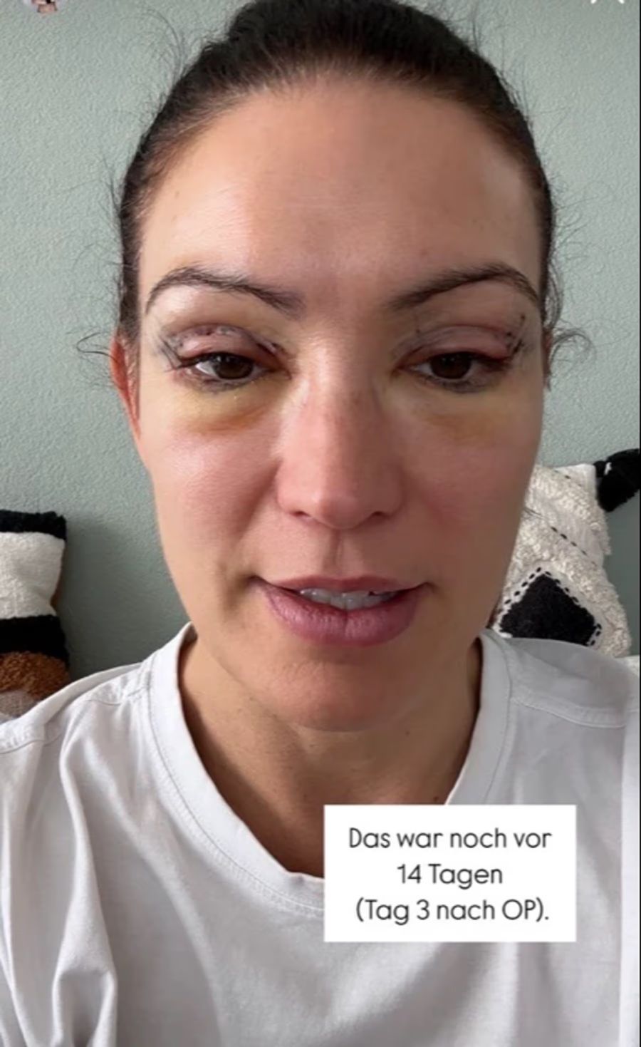 Frieda Hodel zeigte 2024, wie sie nach ihrer ersten Beauty-OP aussah.