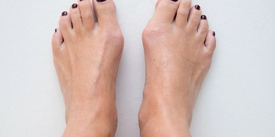 Wer einen Ballenzeh Hallux valgus hat, erkennt das unter anderem am Köpfchen des Mittelfussknochens. Es tritt bei der Fehlstellung oft stark an der Fussinnenseite vor.