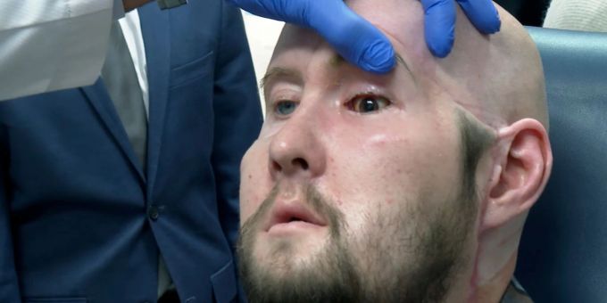 Einem US-amerikanischen Chirurgenteam ist eigenen Angaben zufolge die erste vollständige Augentransplantation weltweit gelungen. Einem US-amerikanischen Chirurgenteam ist eigenen Angaben zufolge die erste vollständige Augentransplantation weltweit gelungen.