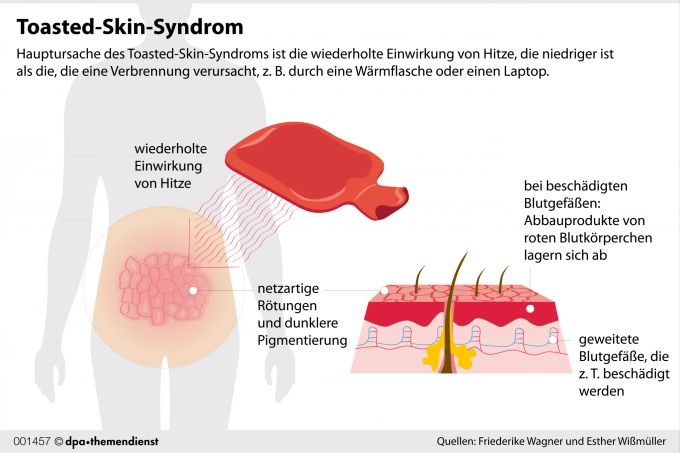 Gitterförmige Verfärbungen der Haut: Wer die an sich beobachtet, ist wahrscheinlich vom Toasted-Skin-Syndrom betroffen. dpa Grafik Wärmflasche Haut