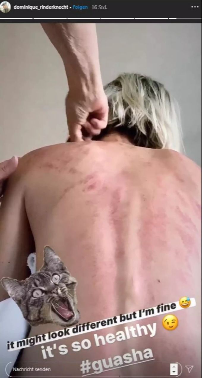 Autsch! Dominique Rinderknecht zeigt ihren geschundenen Rücken. dominique