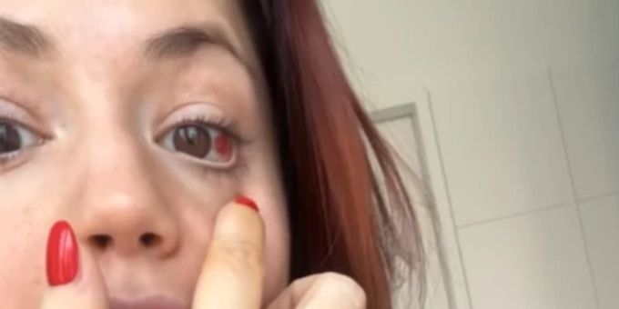 «Mache mir Sorgen» - Hänni-Verlobte schlägt wegen Fleck im Auge Alarm