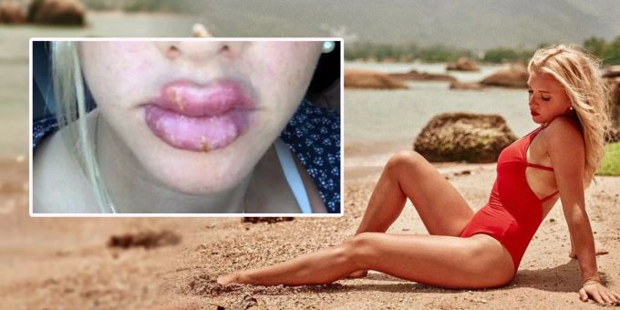 Evelyn Burdecki - Dschungel-Kandidatin platzen die Lippen nach Eingriff