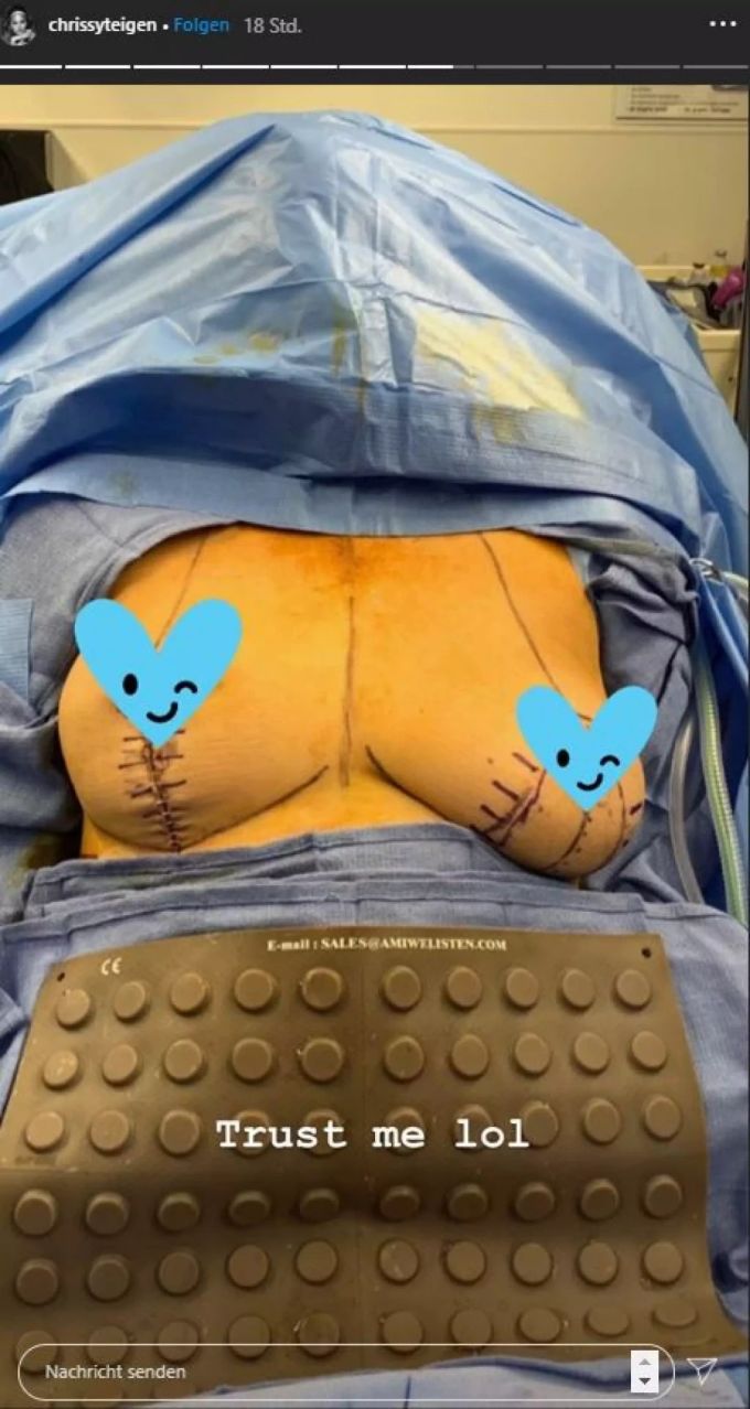 Chrissy Teigen liess sich die Implantate rausnehmen. chrissy