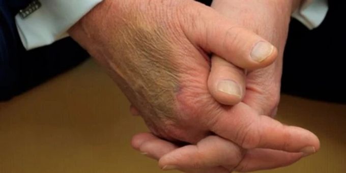 Wie bitte? - Weisses Haus hat bizarre Erklärung für Trumps Hand-Fleck