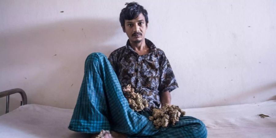Die Warzen an Abul Bajandars Händen sind wieder zurück