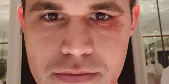 Keine Ruhe - Schachspieler Carlsen holt sich blaues Auge beim Fussball