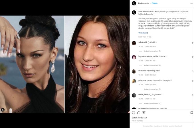 Heute würde sie die Nase nicht mehr operieren, sagt Bella Hadid. Bella Hadid