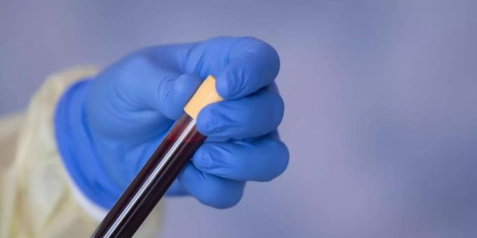 Eine Blutprobe für einen Antikörpertest gegen das Coronavirus. Blutserum