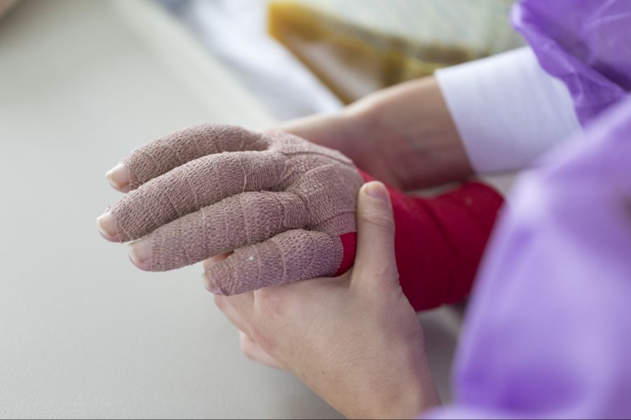 Bei schweren Brandverletzungen können Bakterien in den Blutkreislauf gelangen und lebensgefährliche Komplikationen auslösen. (Symbolbild)