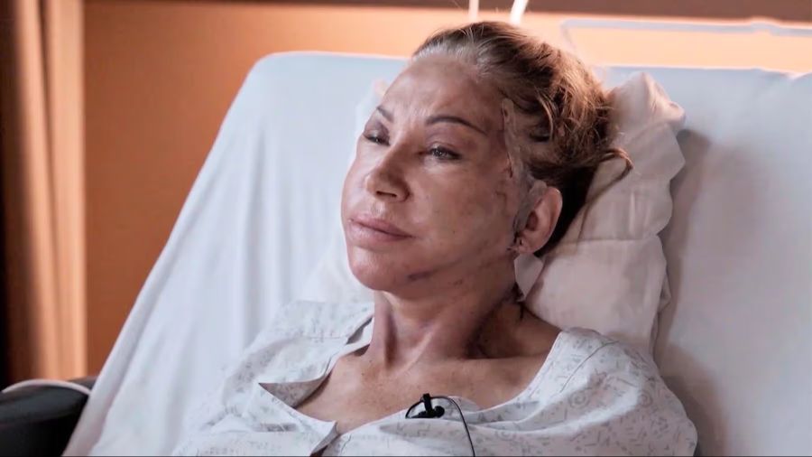 Nach der 8-Stunden-OP war Carmen kaum wiederzuerkennen.
