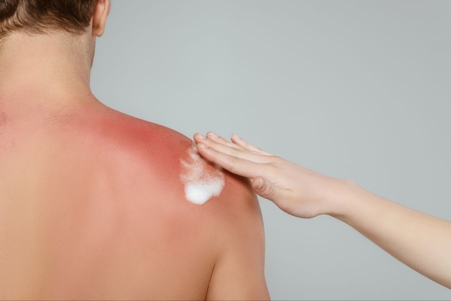 Eine Hand cremt Schulter eines Mannes mit Sonnenbrand ein