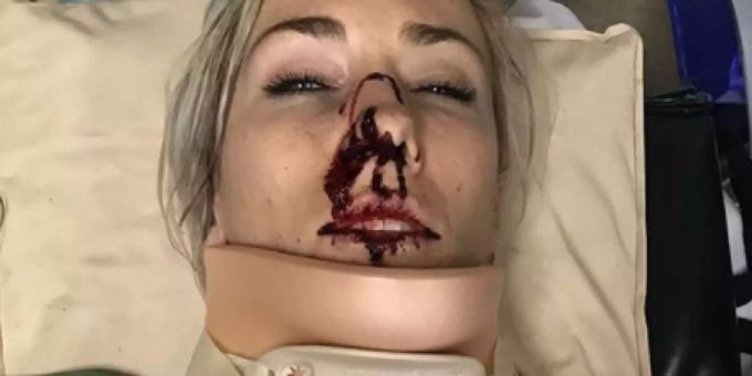 Insta-Grüsse aus Spital - BMX-Weltmeisterin schwer verletzt