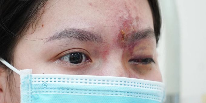Beauty-Pfusch - Teenagerin (17) nach Filler auf einem Auge blind