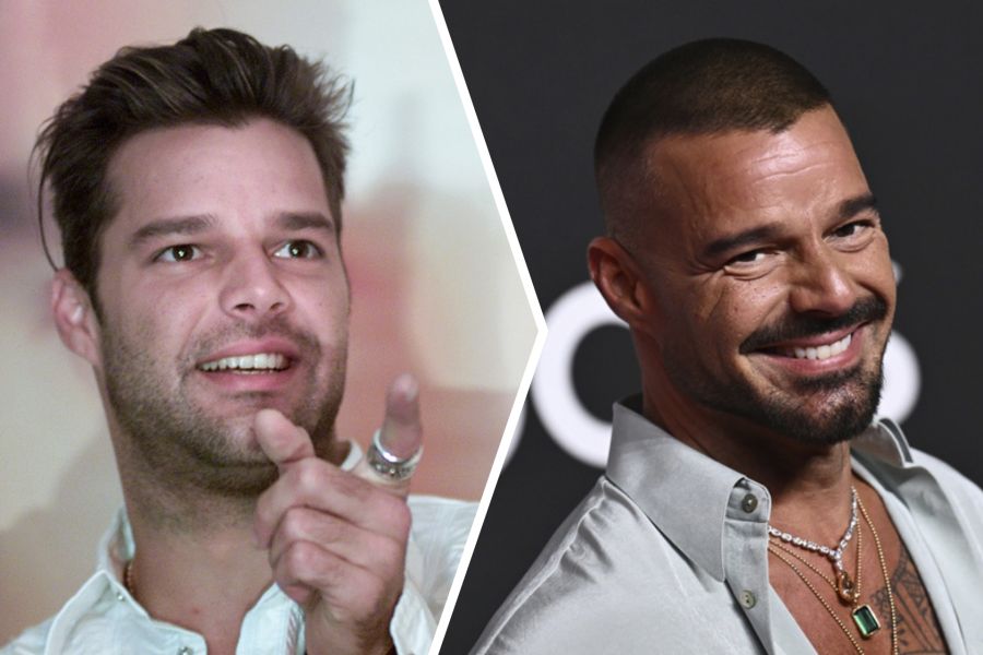 Der Facelift von Sänger Ricky Martin sei jedoch gelungener. Und: Weniger Botox im oberen Gesichtsdrittel, mehr Fokus auf das Untergesicht.
